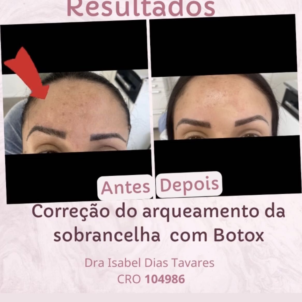 Portfólio de Botox facial- toxina botulínica!