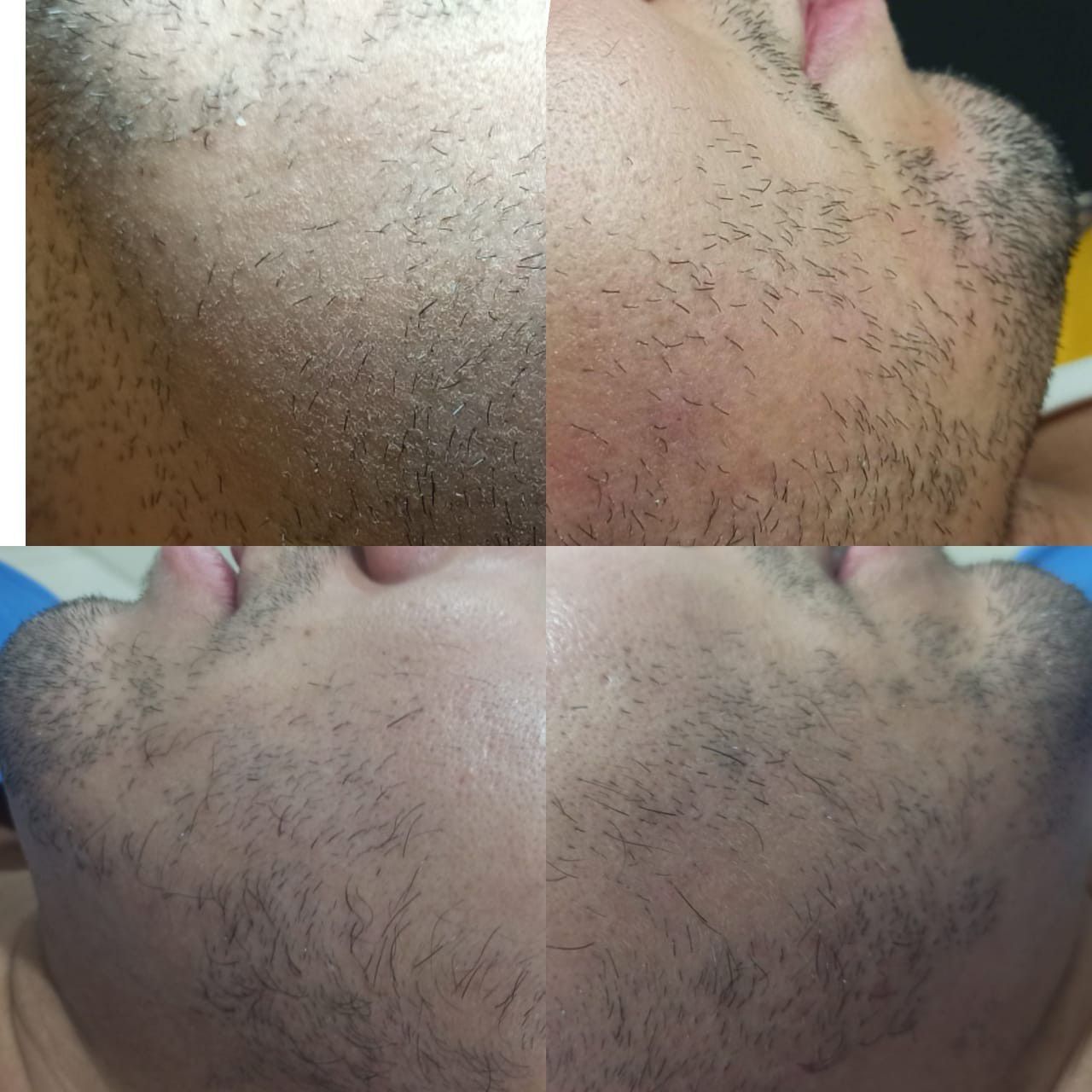 Portfólio de 🧔Tricologia em barba
