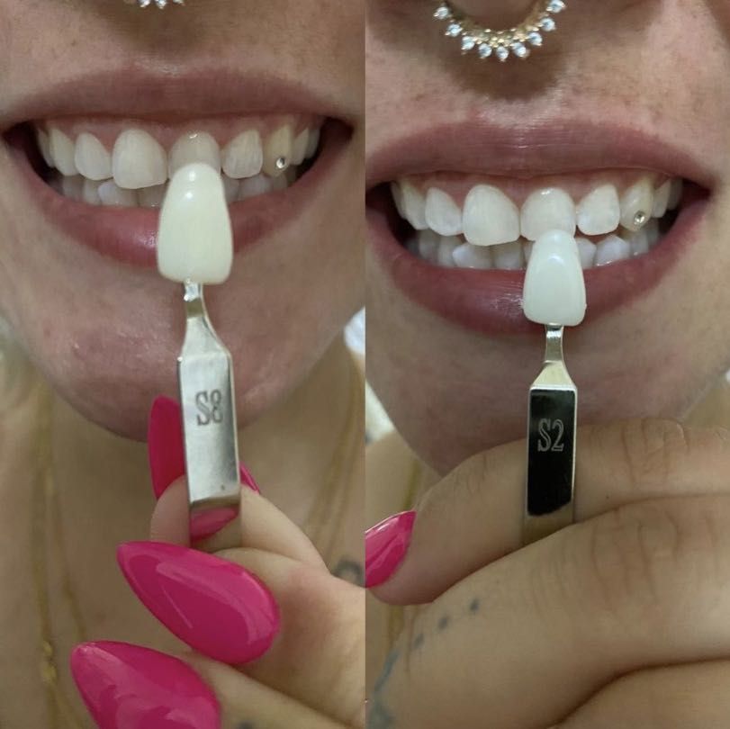 Teeth whitening regular treatment portfolio