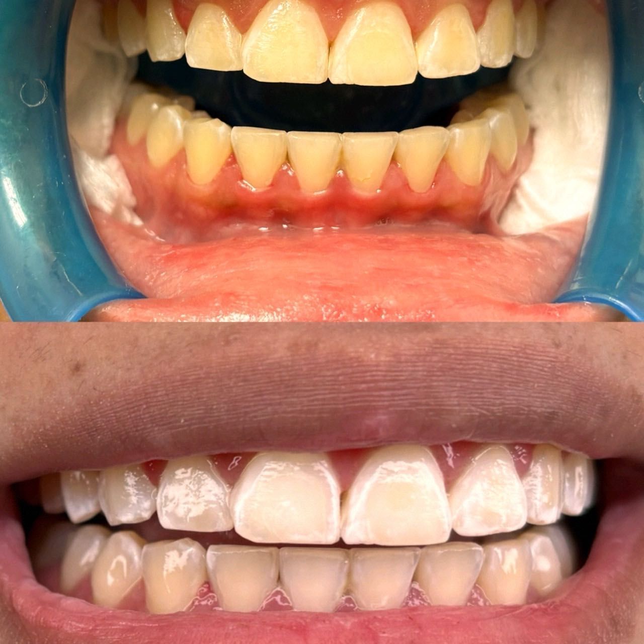 Teeth whitening portfolio