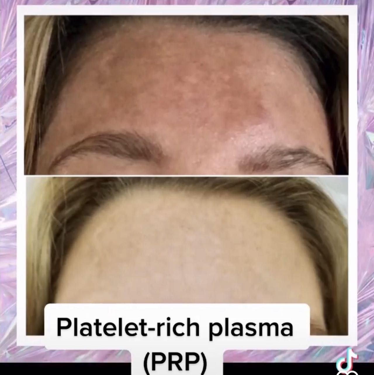 PRP platelet rich plasma full face portfolio