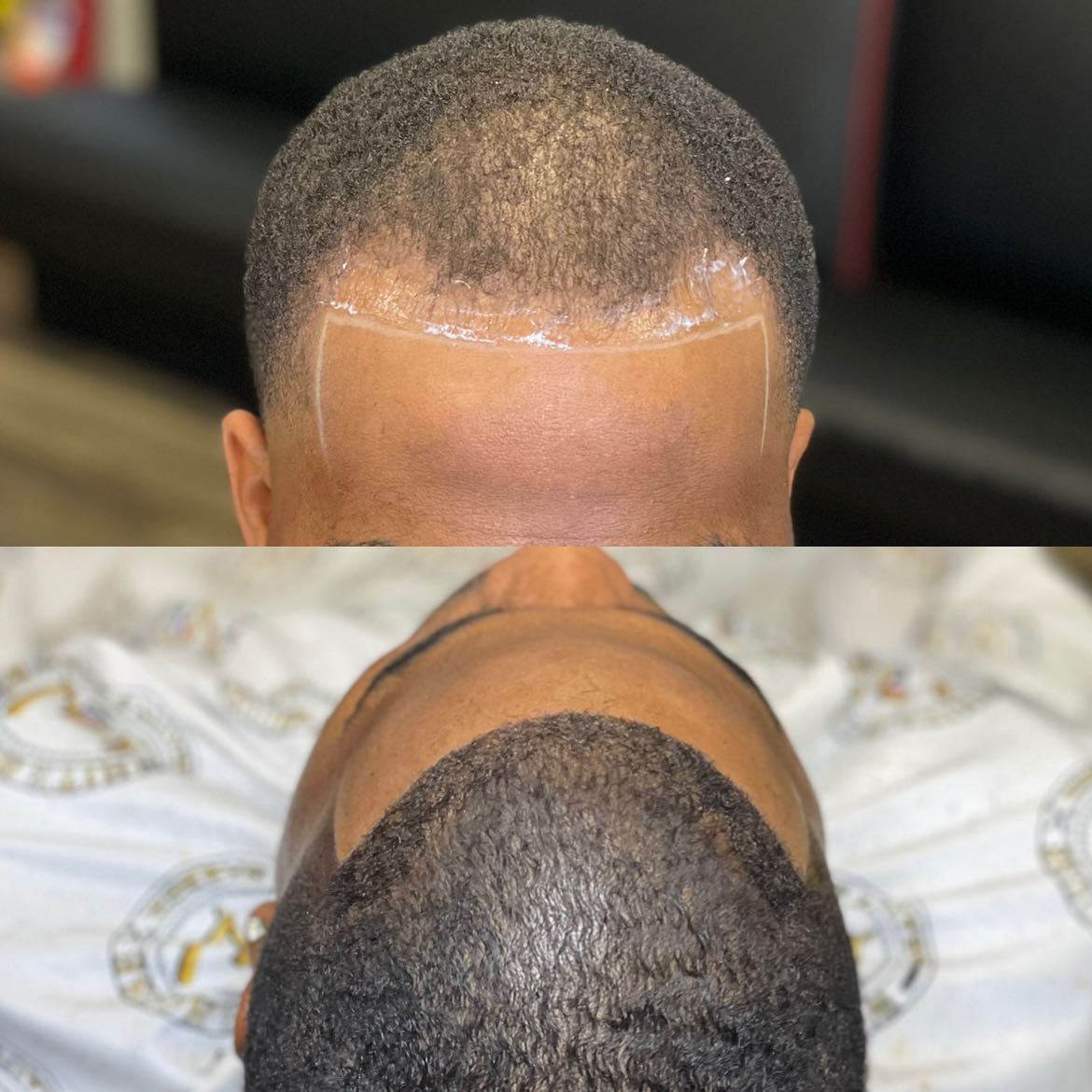 Hairline Replacement (2-3 Weeks) **CALL TO BOOK** portfolio