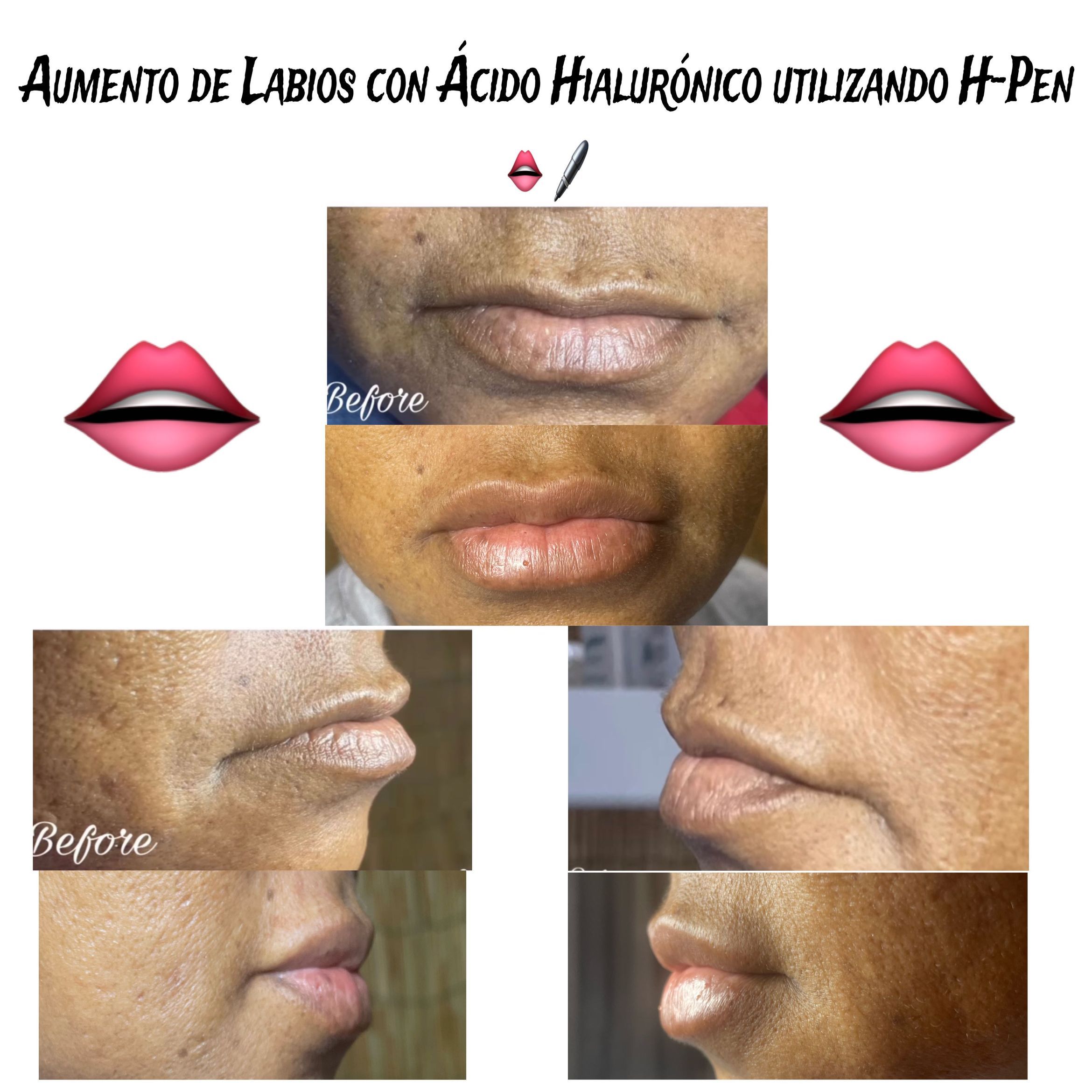 Aumento labios con Ácido Hialurónico 👄🖊 portfolio