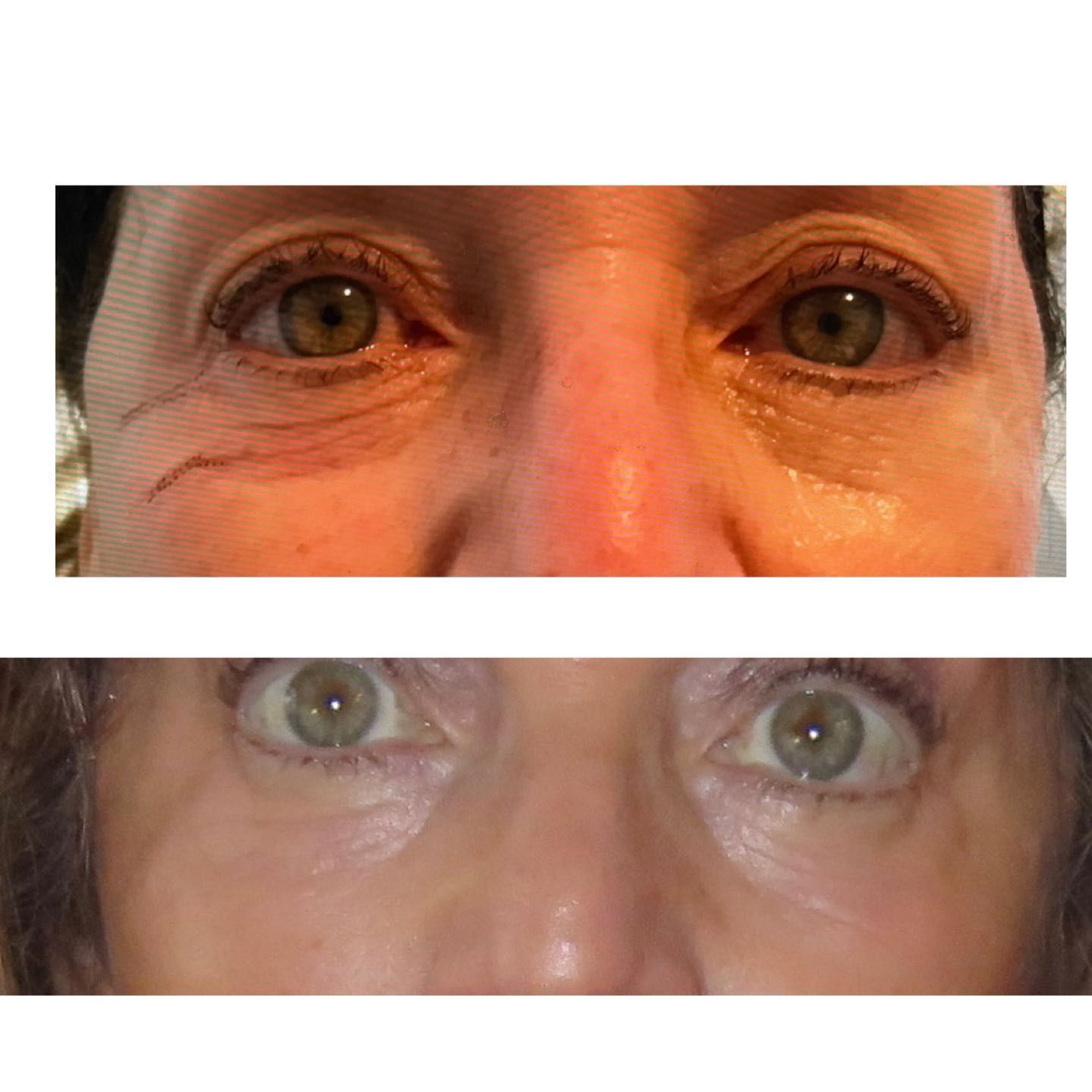 Blepharoplasty, Periorbital region, upper eyelids portfolio
