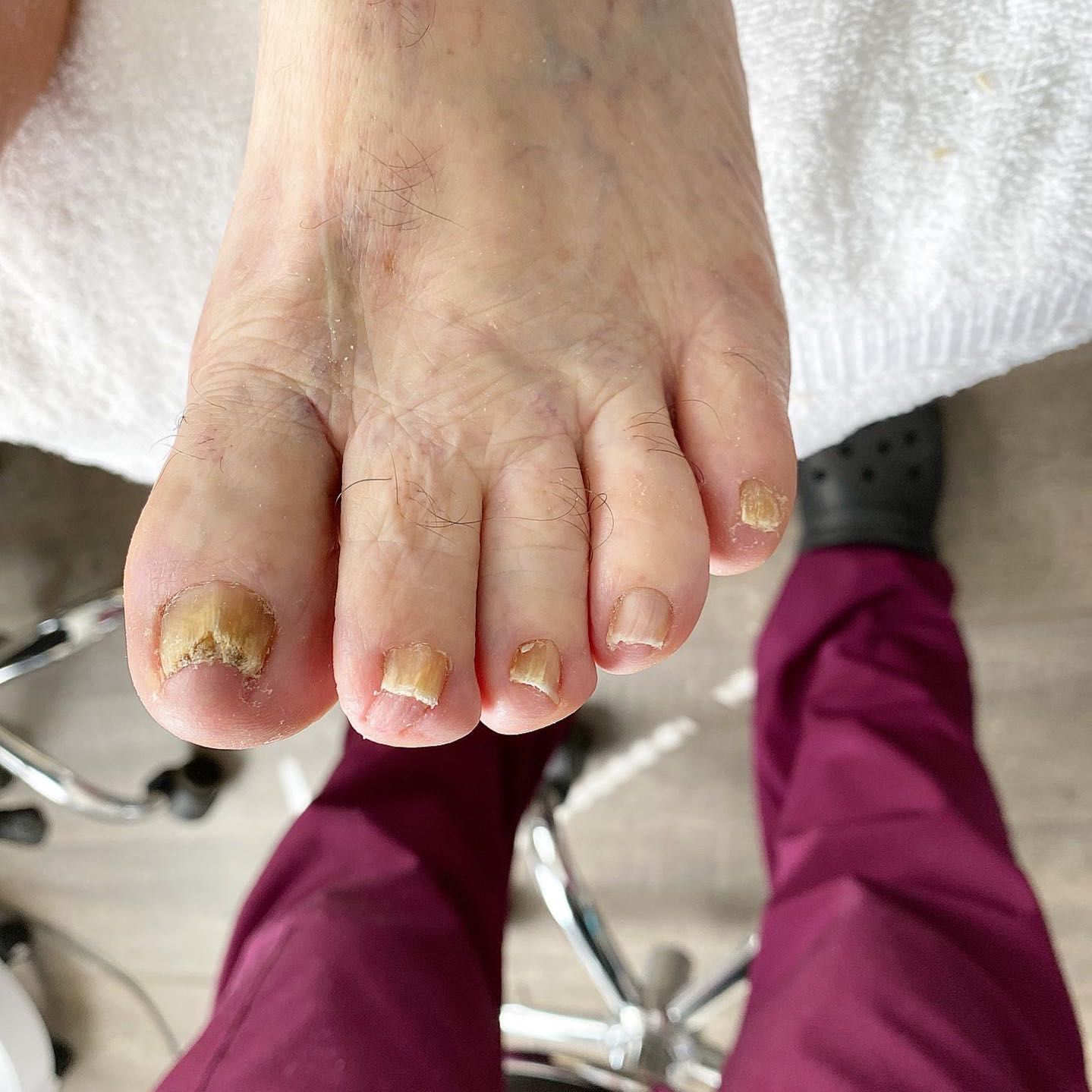Toes nail cut only👣 or medical toe nails cut portfolio