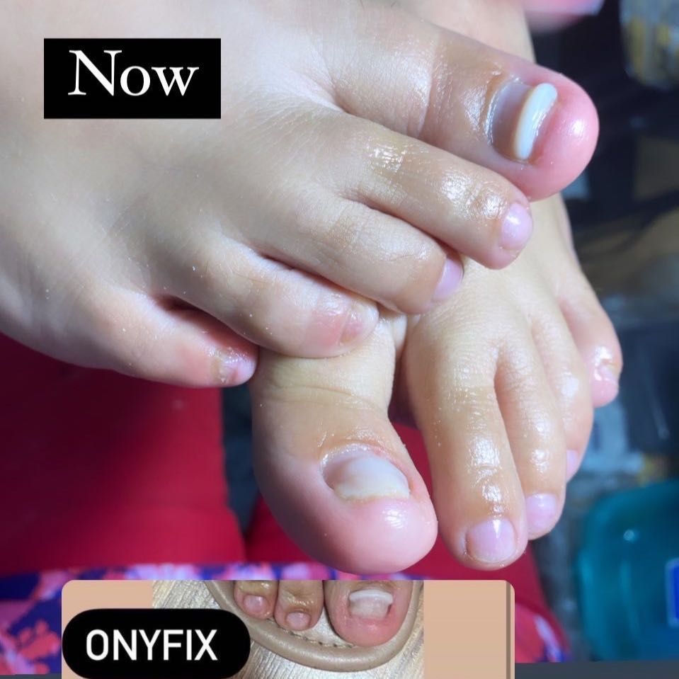 Onyfix 👣 💅🏾 Nail correction portfolio