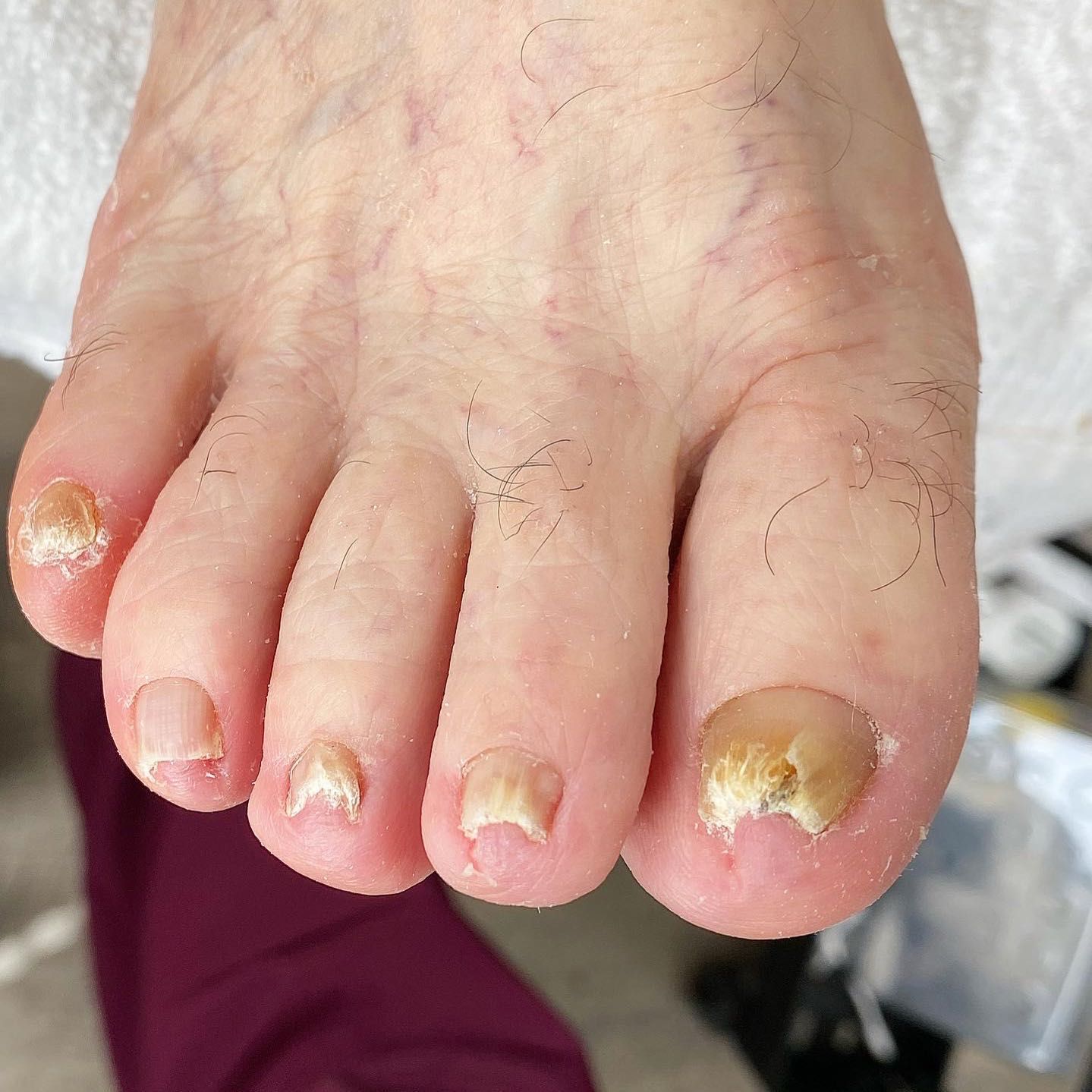 Toes nail cut only👣 or medical toe nails cut portfolio