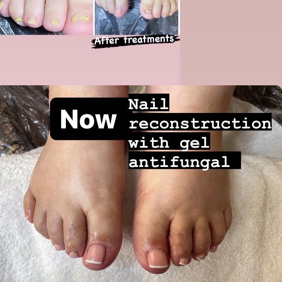 Nail Reconstrucion👣 💅🏾 With antimicrobial gel only portfolio