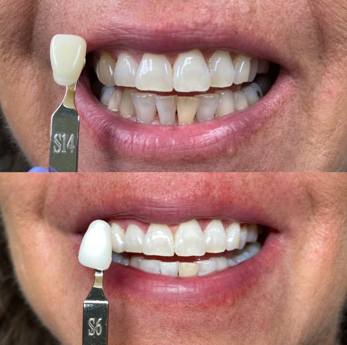 Cosmetic Teeth Whitening portfolio