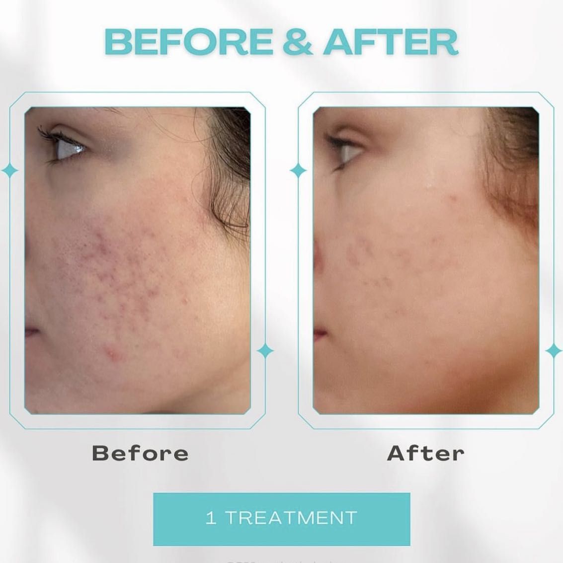 Microchanneling : Fine Lines or Acne Scarring portfolio