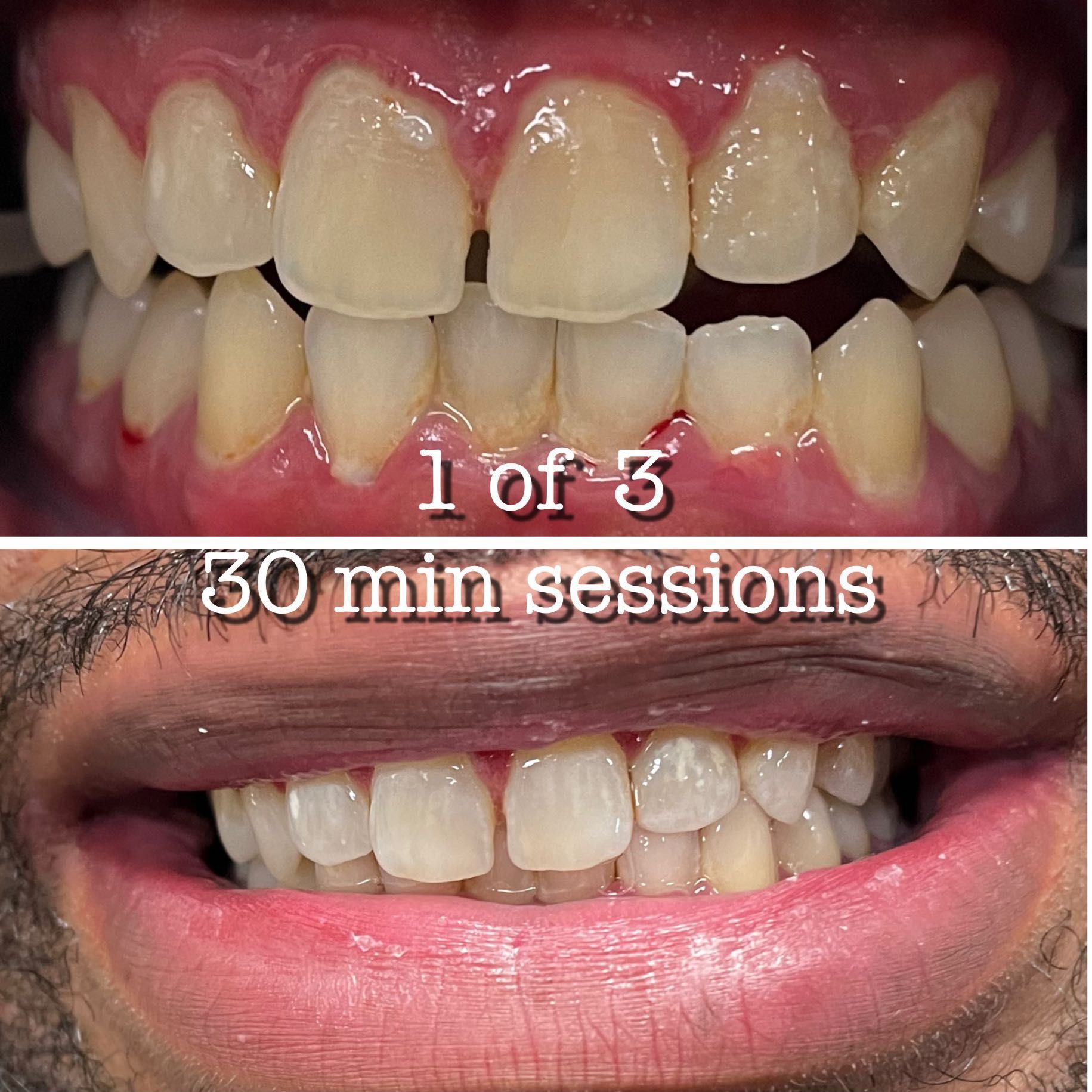 Ultra sonic teeth whitening portfolio