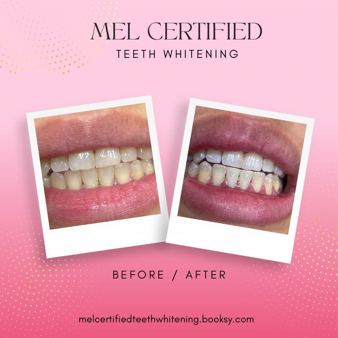 Teeth whitening portfolio