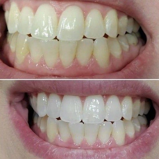 LED Teeth Whitening portfolio