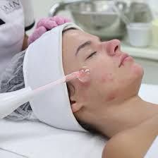 Acne Treatment Facial portfolio
