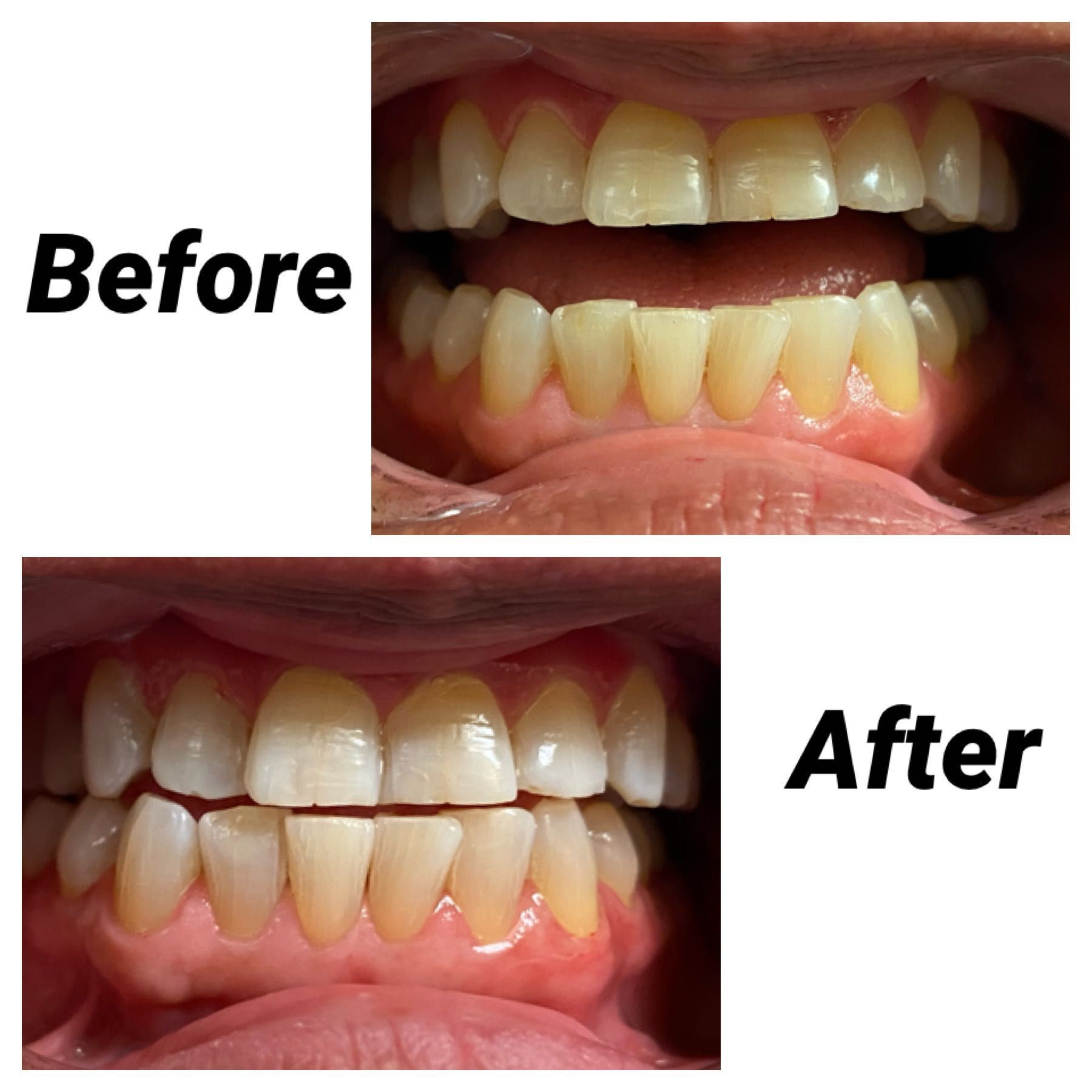 Laser teeth whitening portfolio