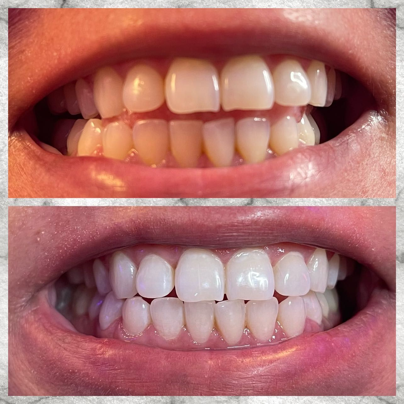 Laser teeth whitening portfolio