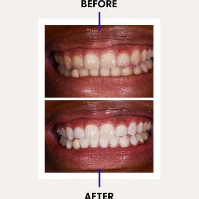 Teeth Whitening (30 Minutes portfolio