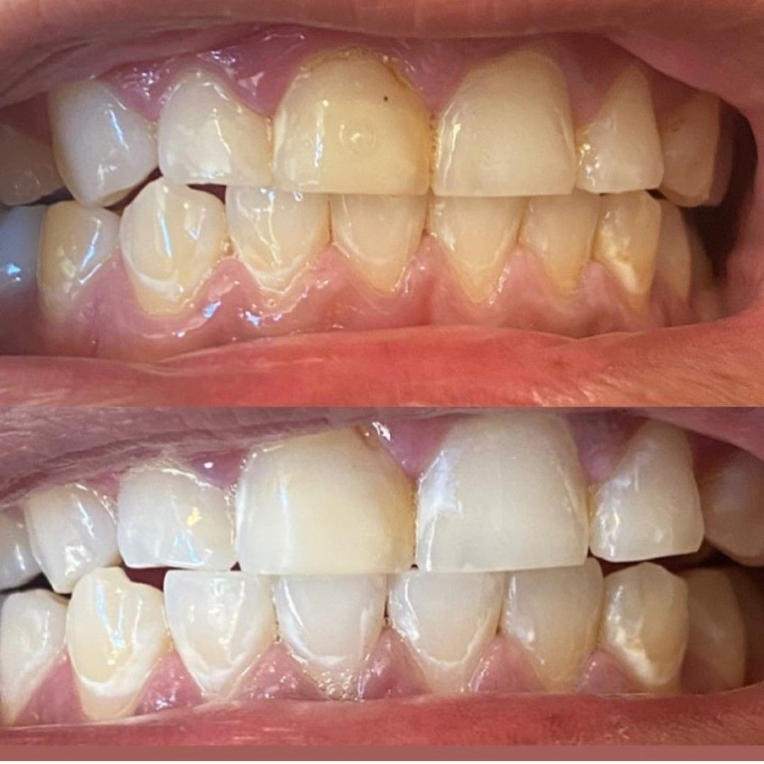 Teeth Whitening (30 Minutes portfolio