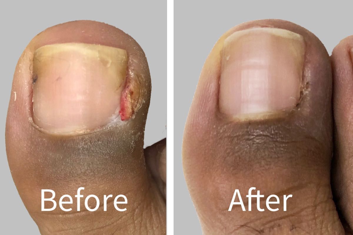 Spa Pedicure with ingrown toenail removal portfolio