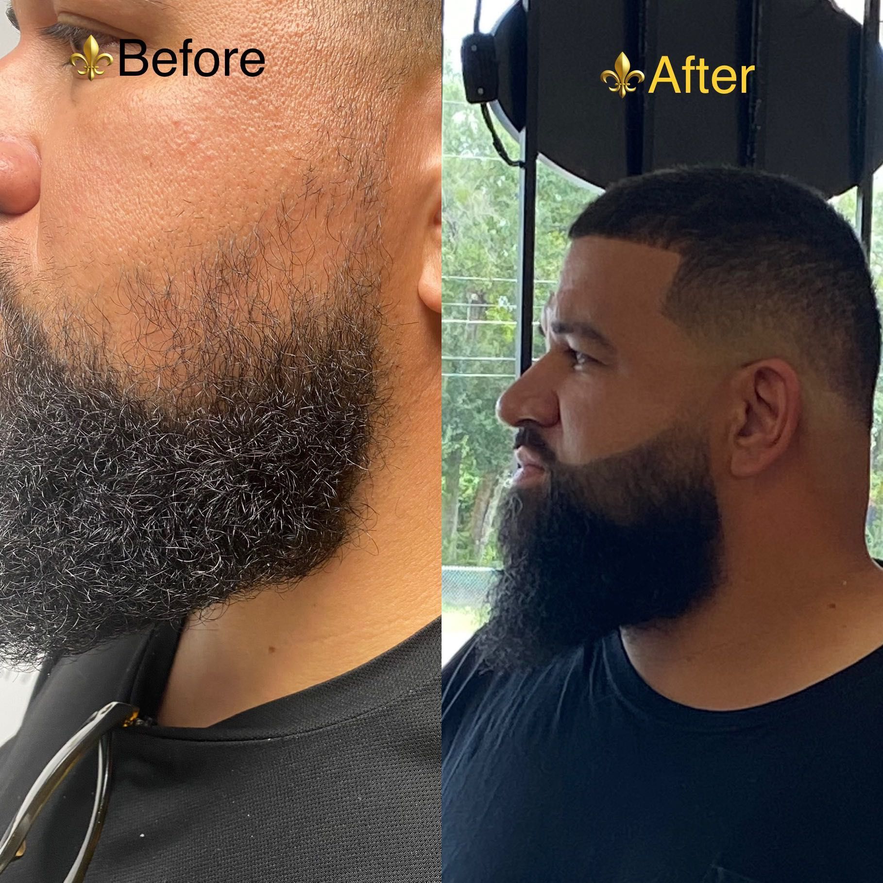 Permanent beard enhancement portfolio