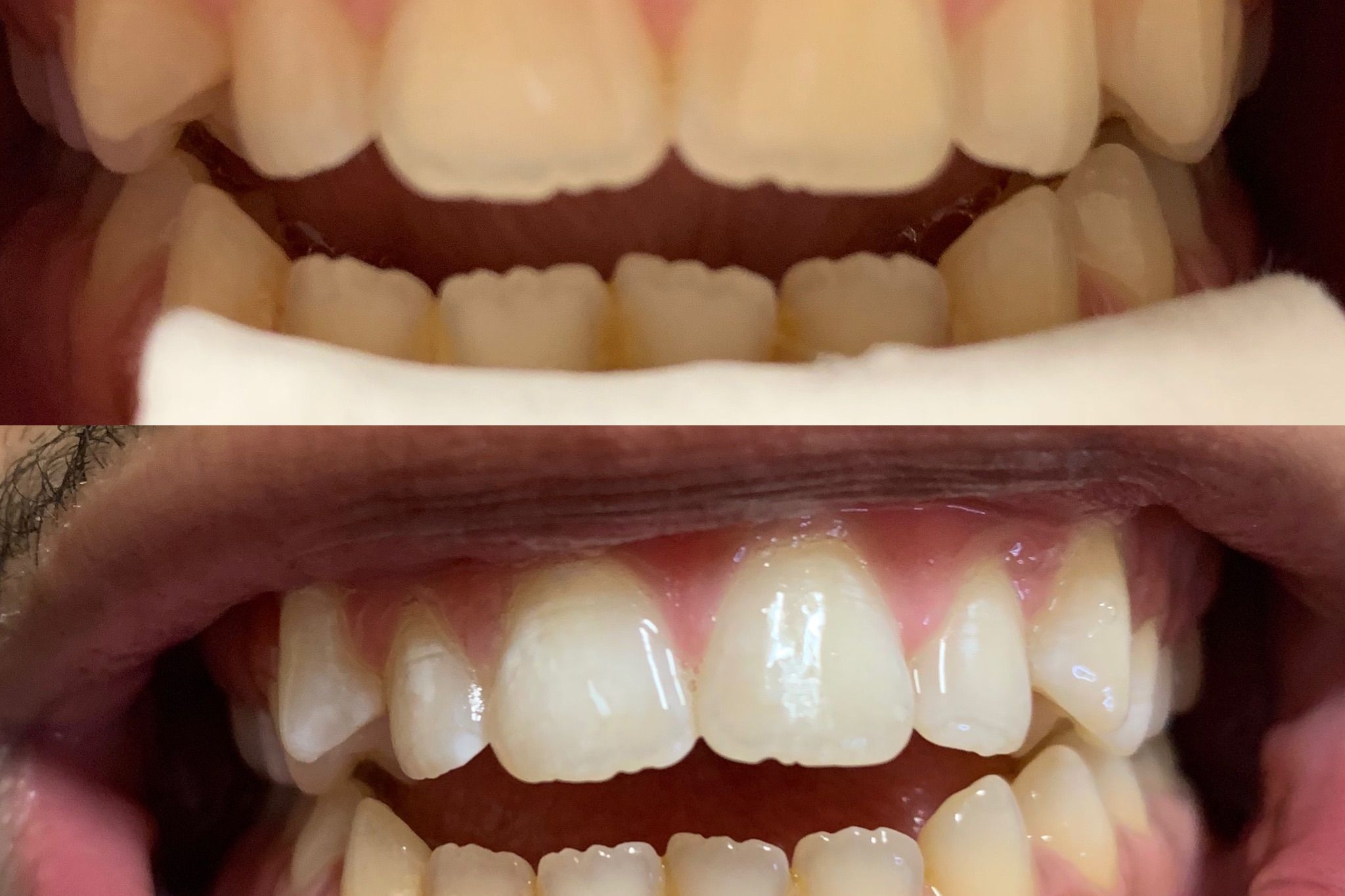 Teeth Whitening 1 Hour Session portfolio