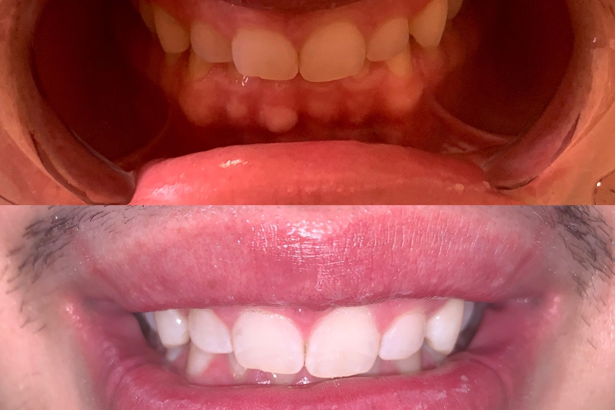 Teeth Whitening 1 Hour Session portfolio