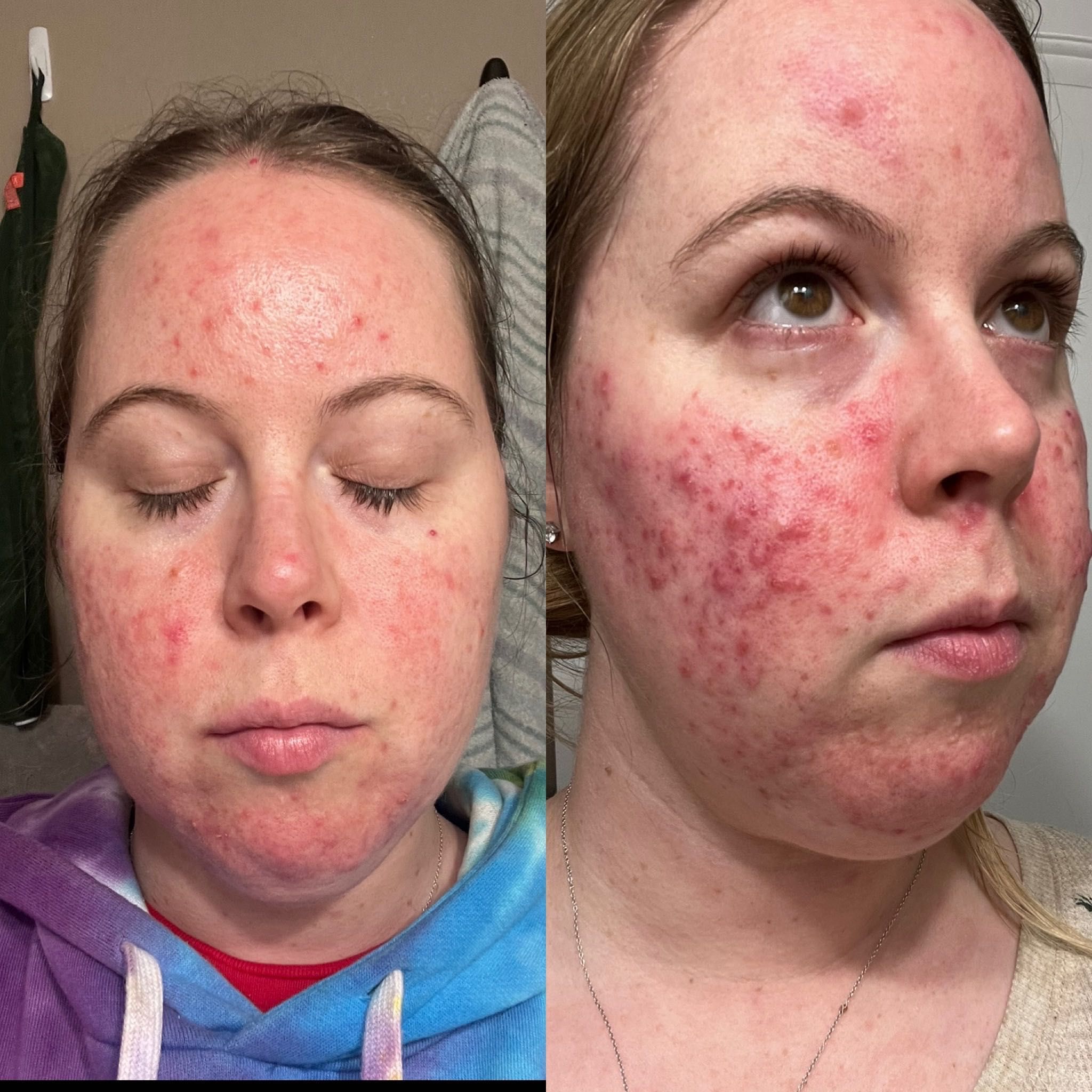 Acne BOOTCAMP FOLLOW UP (3 weeks ONLY) portfolio