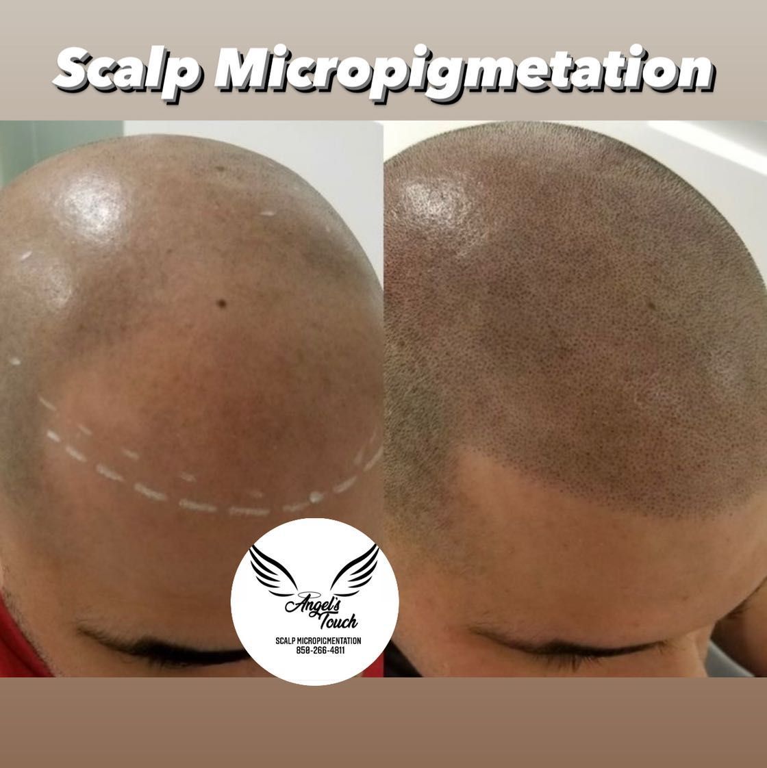 Scalp micropigmentation portfolio