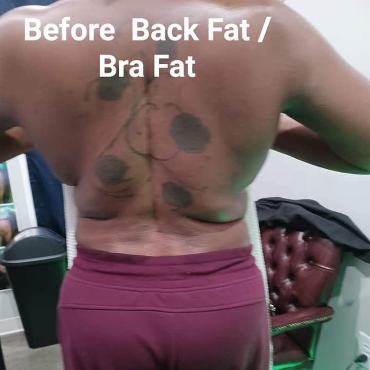 Back Fat / Bra Fat ( 6 treatment) portfolio