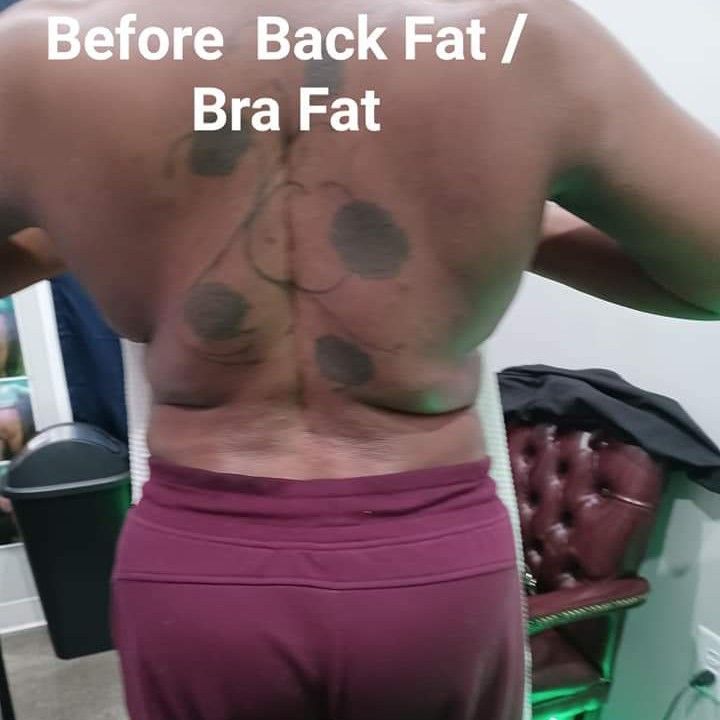 Back Fat / Bra Fat portfolio