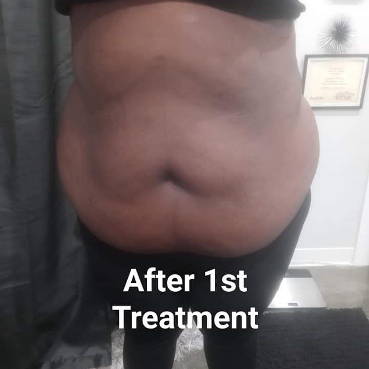 Special Non- Invasive 4  Treatment  ( Stomach ) portfolio