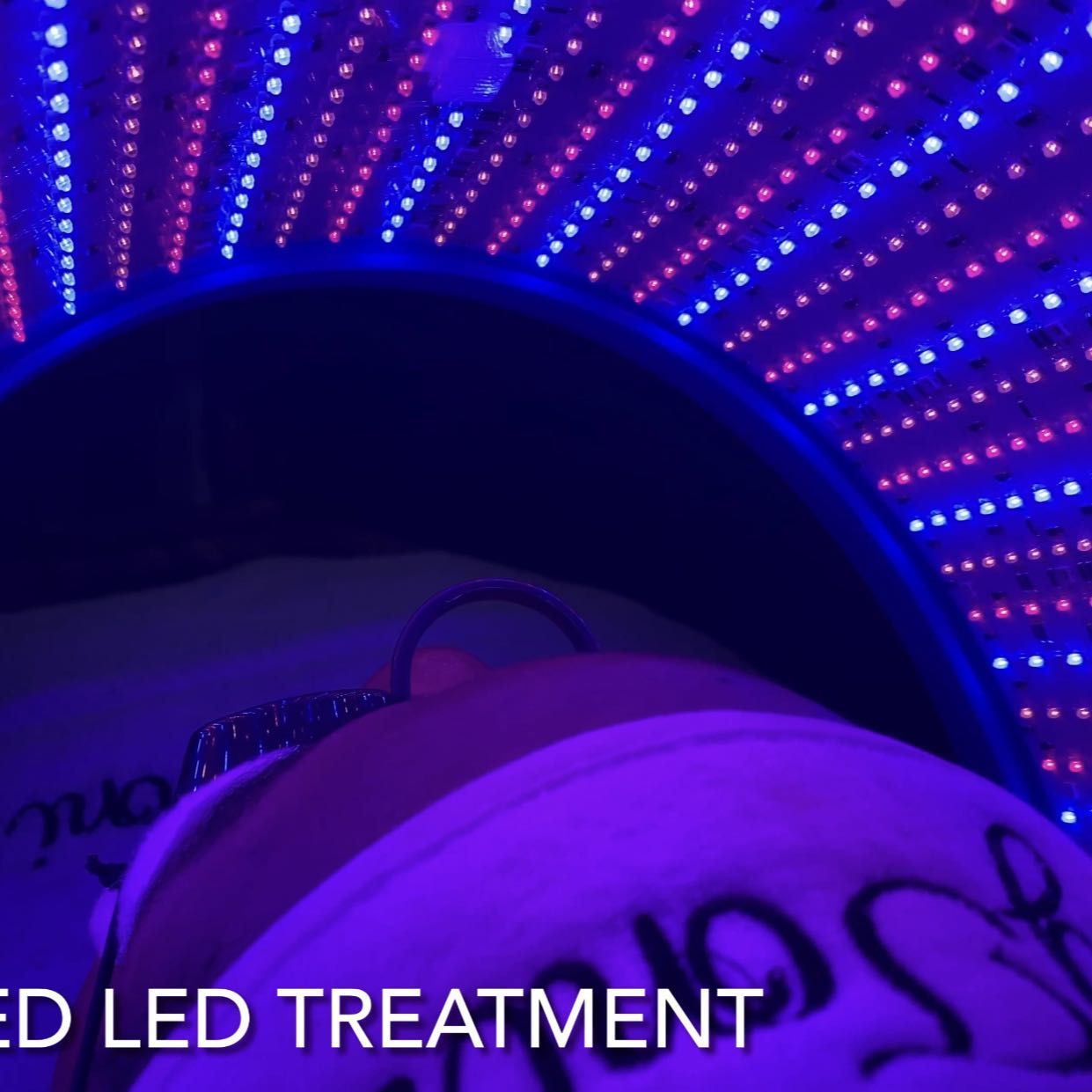 LED Therapy & Chemical Pell Acne Treatment portfolio