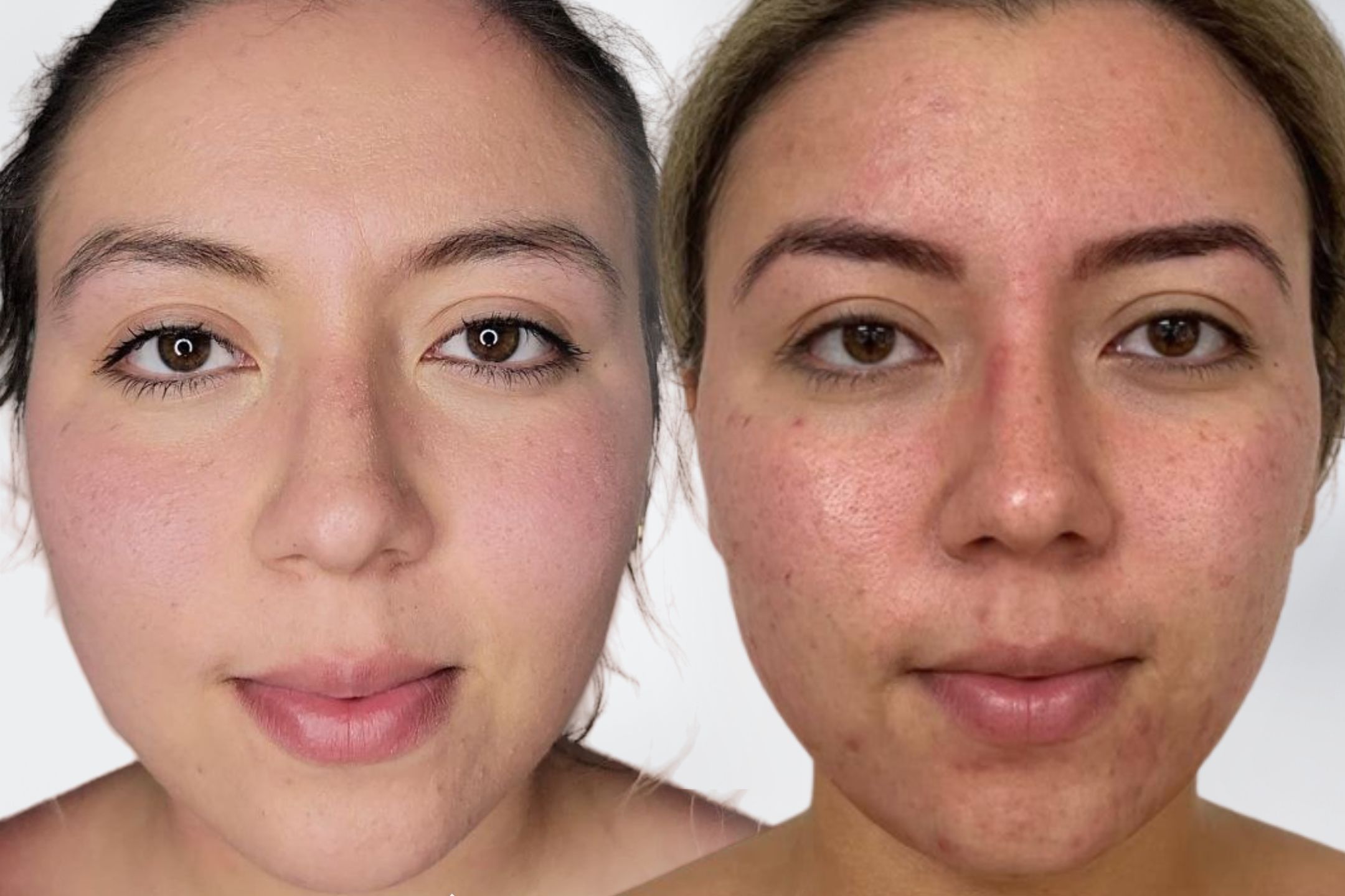 DA Facial & Body Anti Acne portfolio