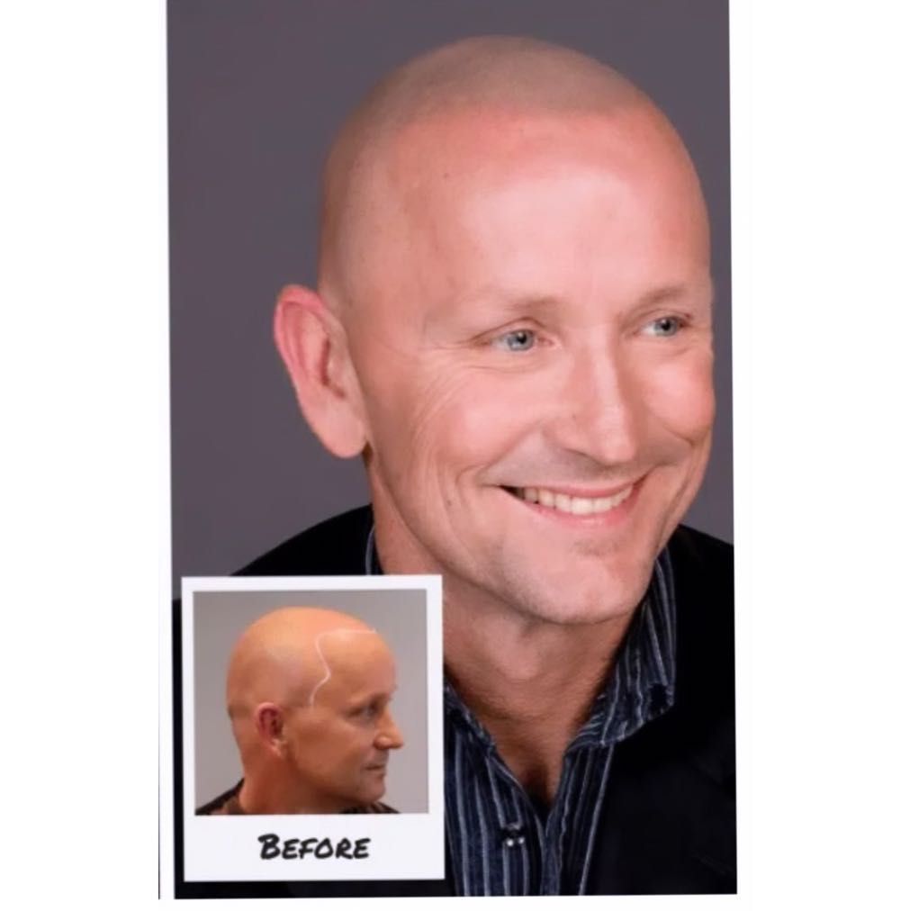 Mens scalp micro pigmentation portfolio