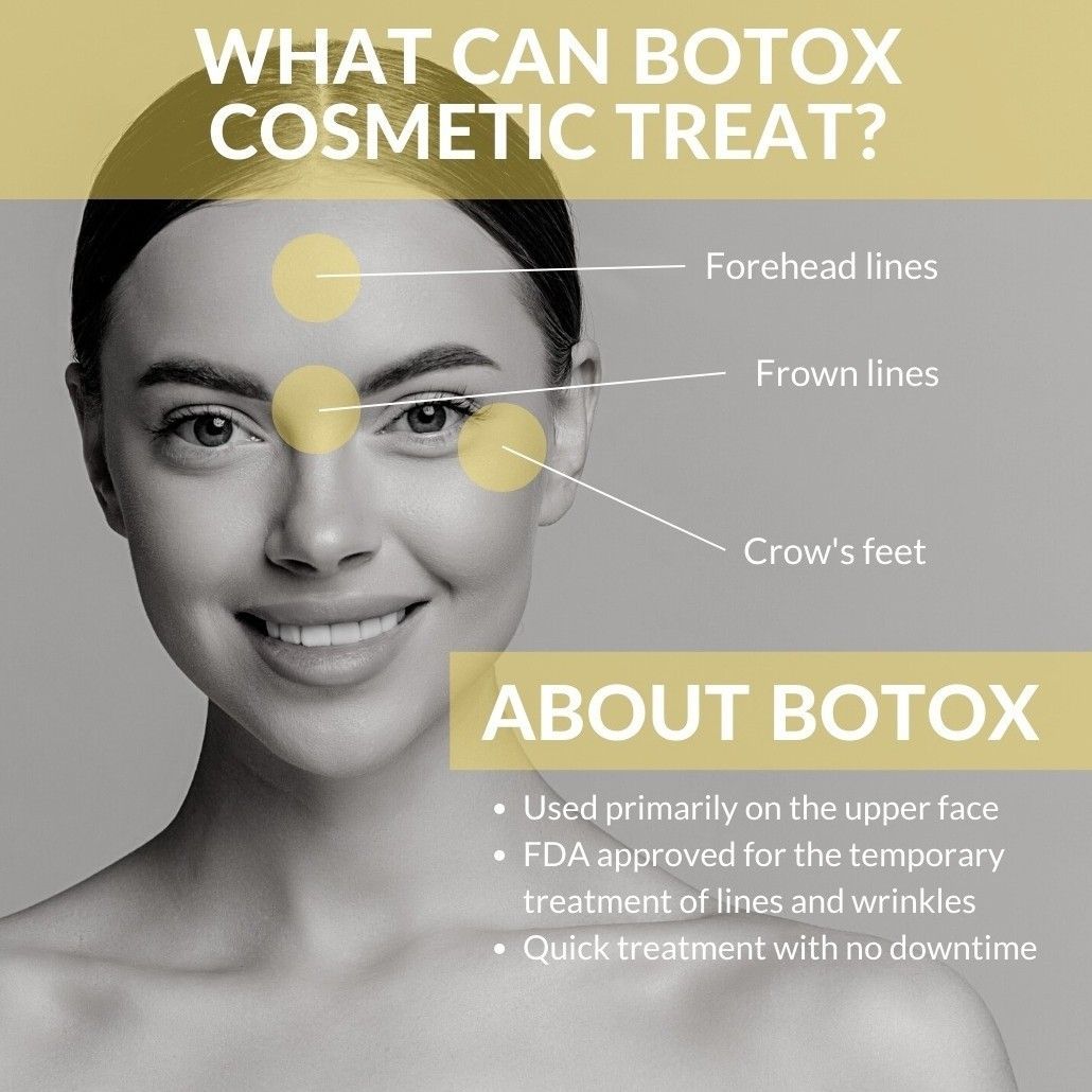 Botox (XEOMIN) 10 Unit portfolio
