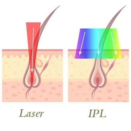 IPL Laser Hair Removal portfolio