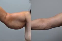 Brachioplasty- Arm lift or liopsution. portfolio