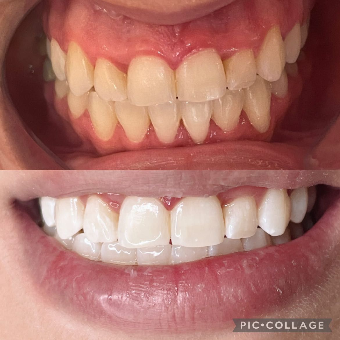 Teeth Whitening Promo - Regular portfolio