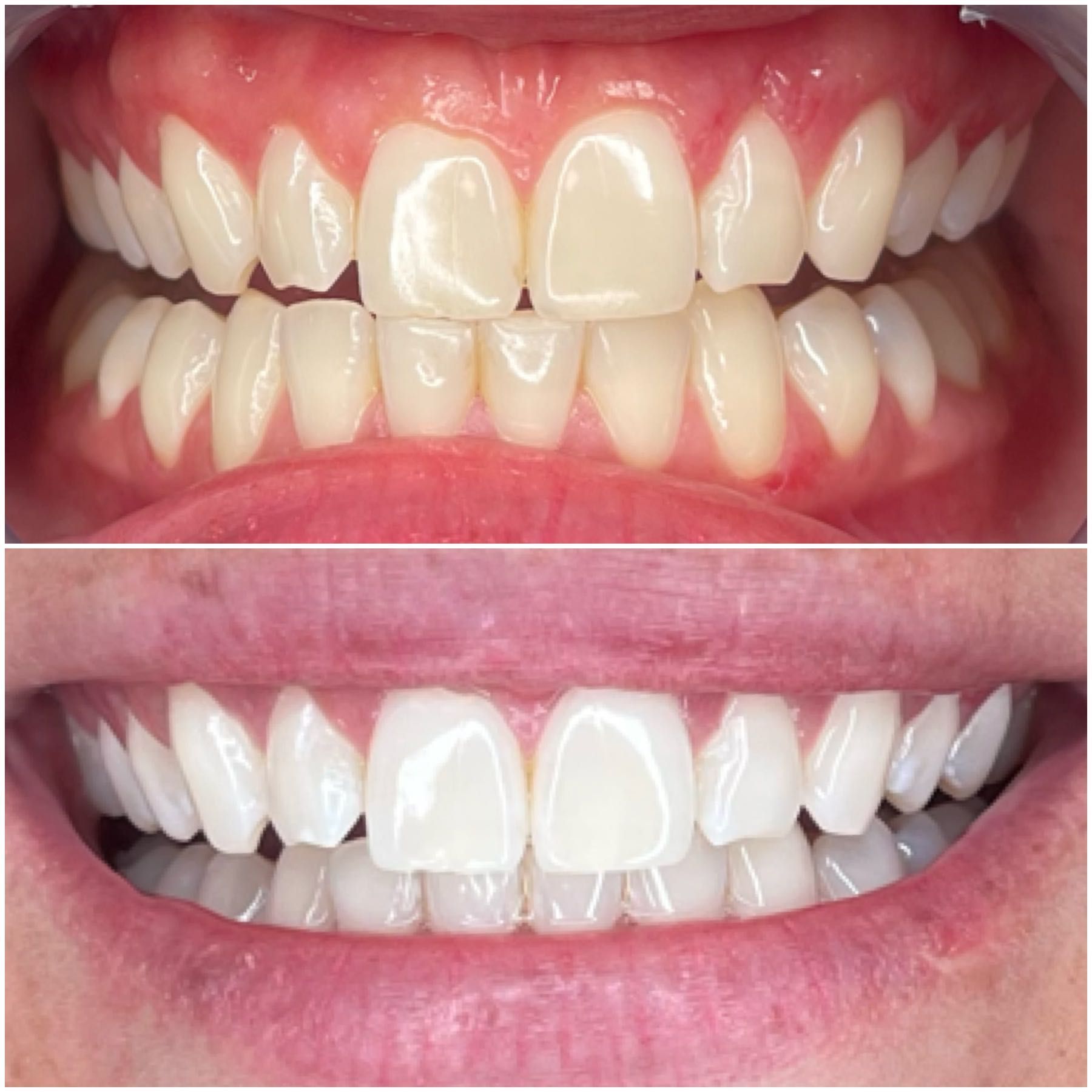 Teeth Whitening portfolio