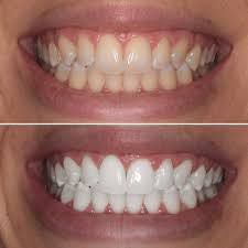 Teeth whitening 20 minutes portfolio