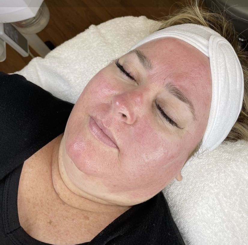 Microneedling: PRP Collagen Induction Therapy portfolio