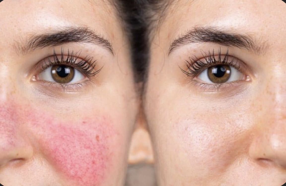 Rosacea or Sensitive skin Facial/Facial rosácea portfolio