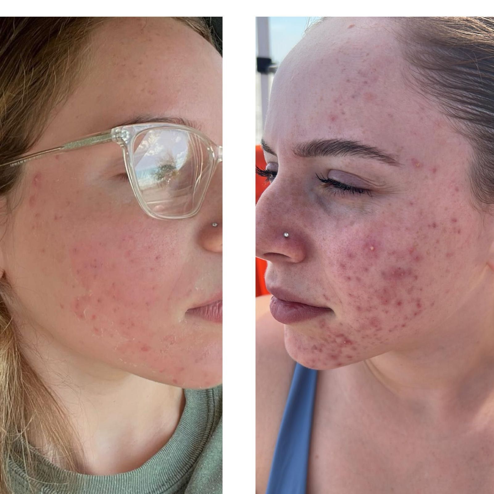 Acne package treatment deep cleaning and peeling portfolio