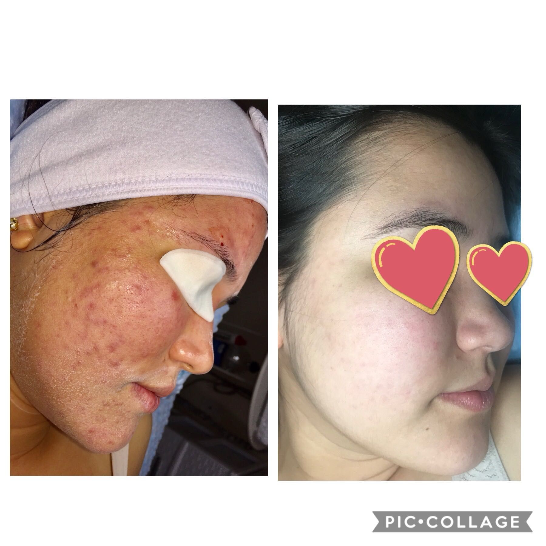 Acne package treatment deep cleaning and peeling portfolio