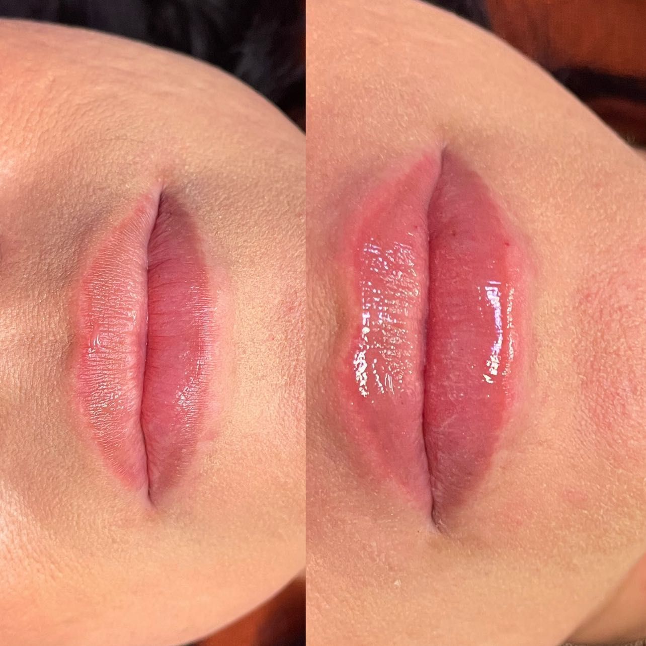 Lip fillers with hyaluronic pen portfolio
