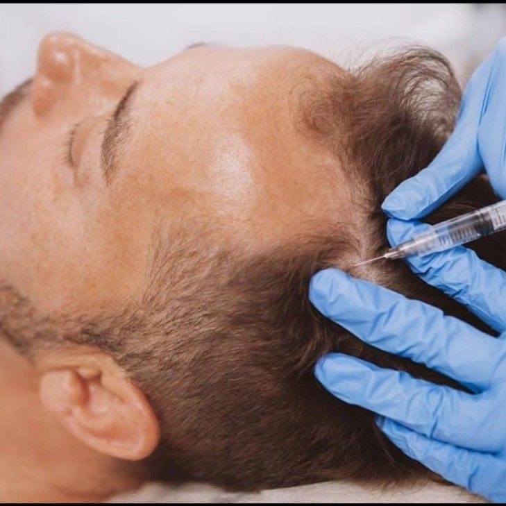 PRP INJECTIONS FOR HAIR RESTORATION AND GROWTH portfolio
