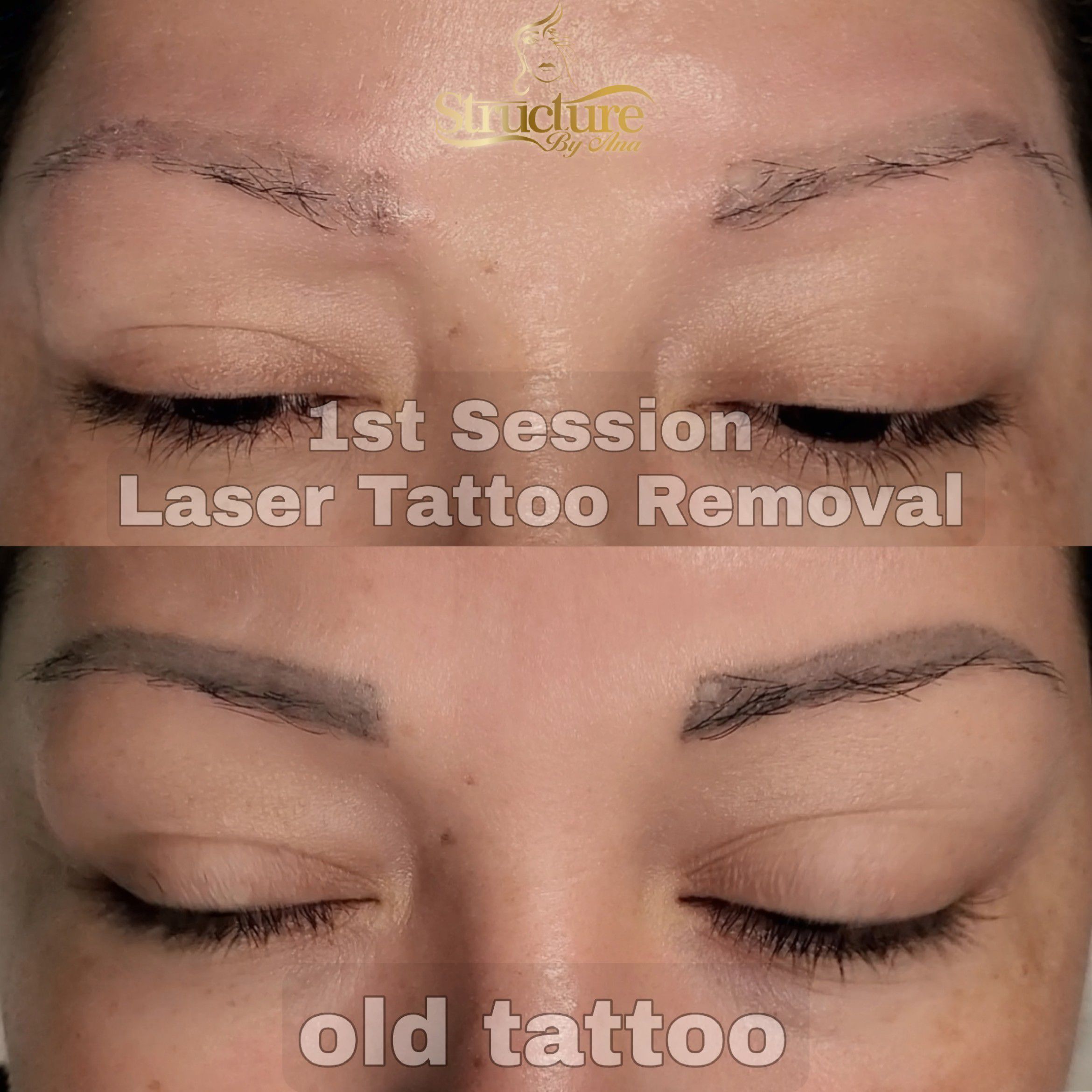 Laser Tattoo Removal x Session portfolio
