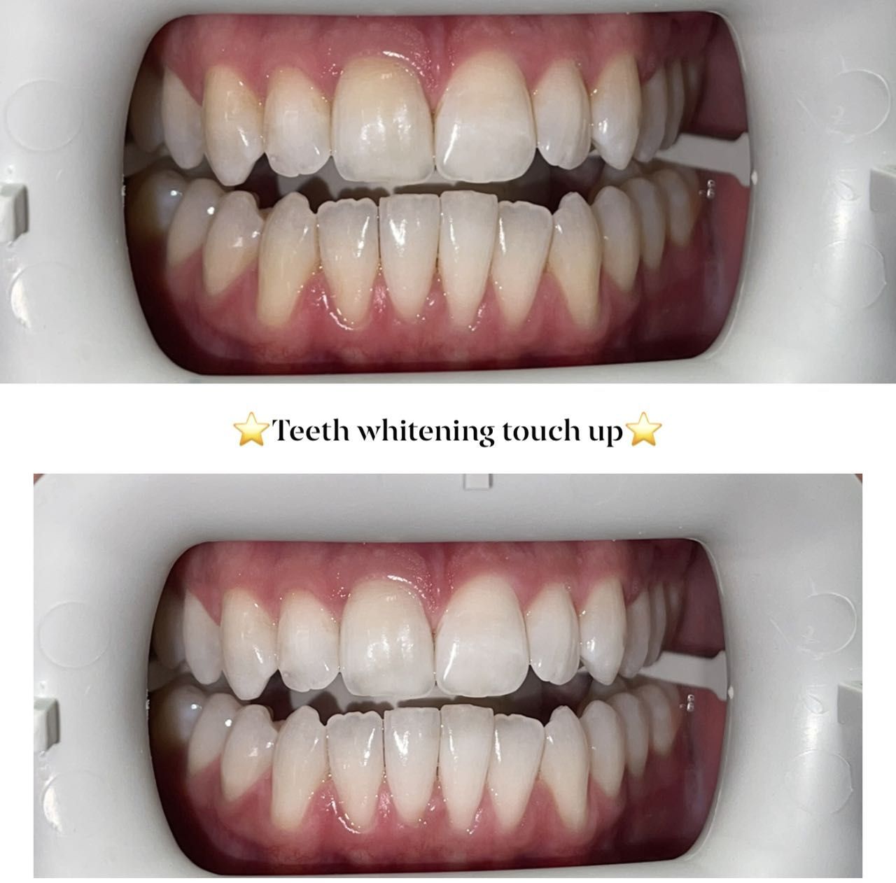 Teeth whitening touch up only portfolio