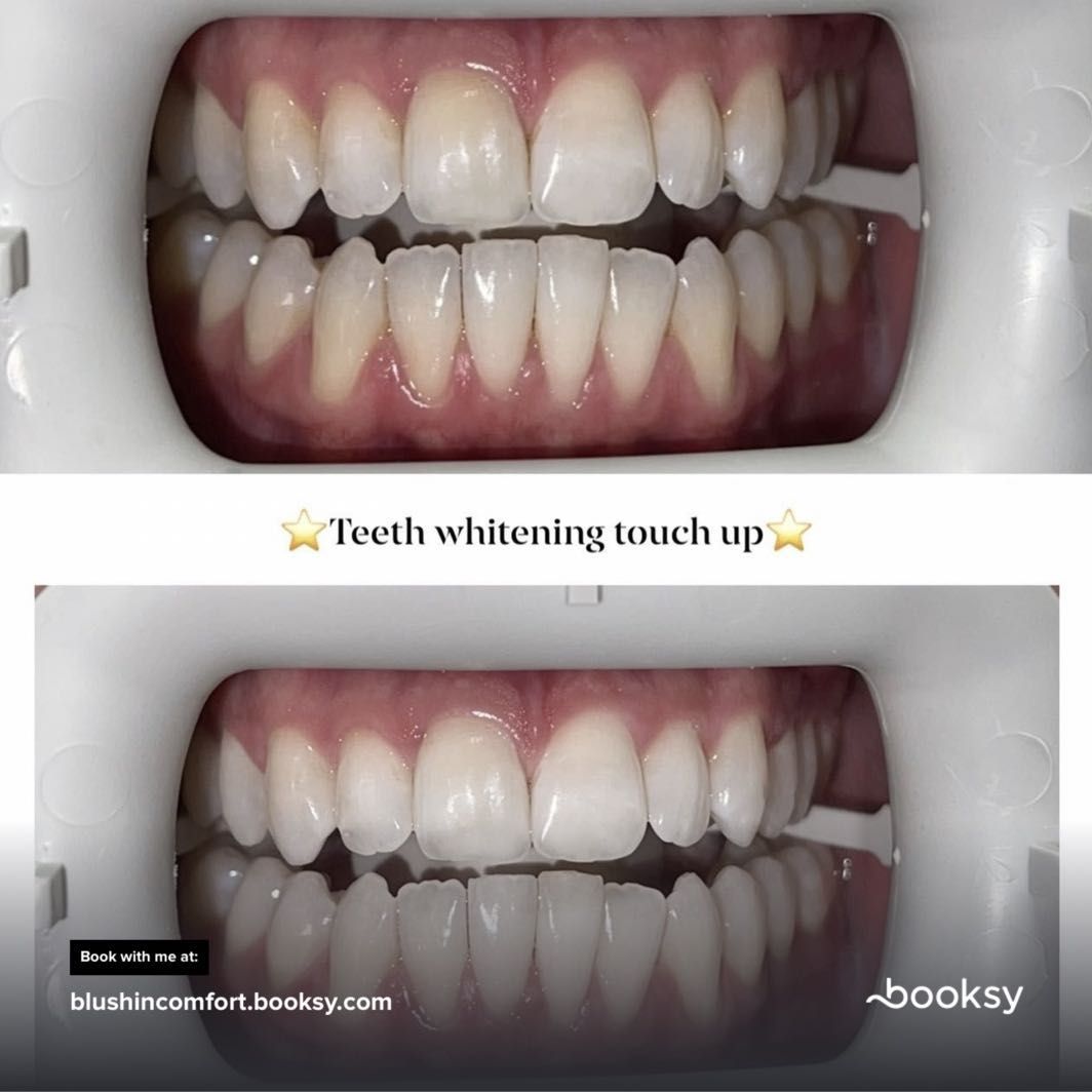 BC Teeth whitening portfolio