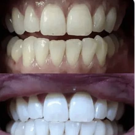 Teeth whitening / Blanquiamento Dental portfolio